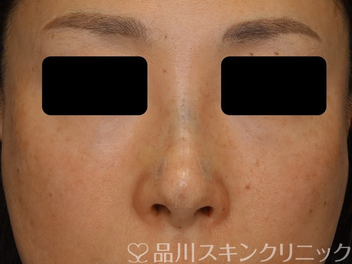 症例NO.74630のAFTER写真