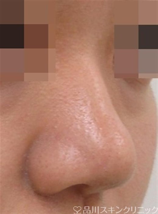 症例NO.40816のAFTER写真