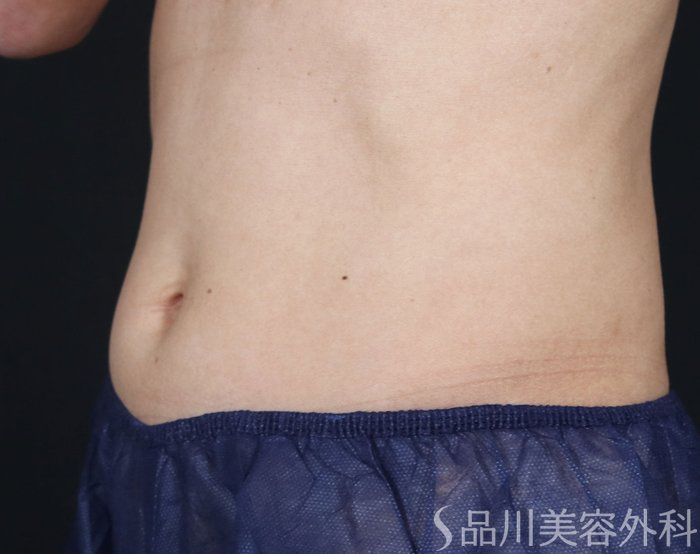 症例NO.72564のAFTER写真