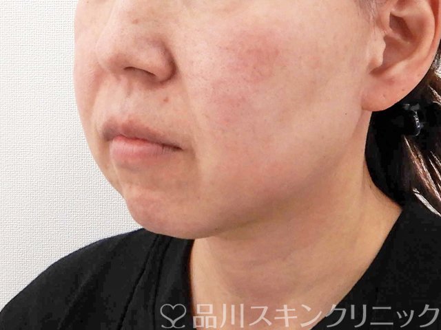 症例NO.62851のBEFORE写真