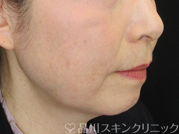 症例NO.73156のBEFORE写真