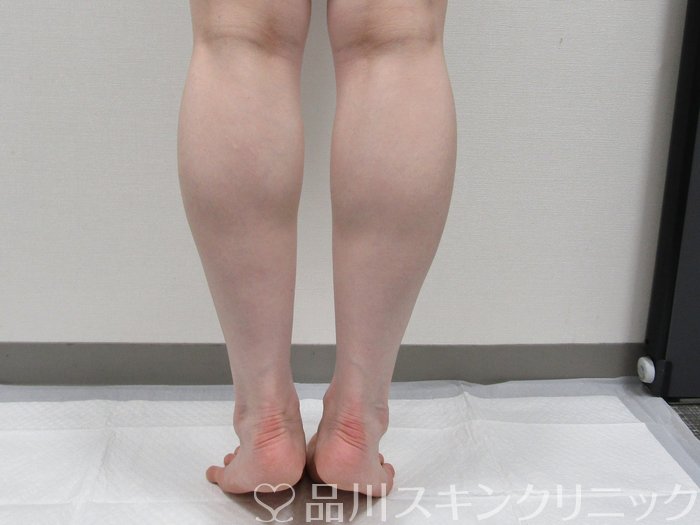 症例NO.74982のAFTER写真