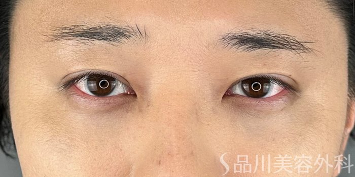 症例NO.72839のAFTER写真