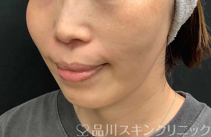 症例NO.71036のAFTER写真