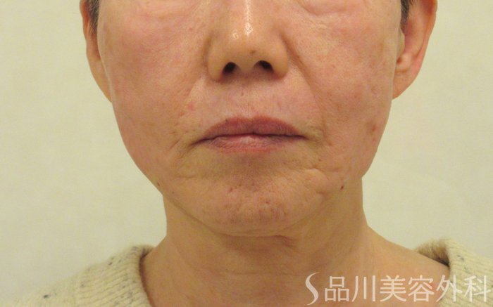 症例NO.73408のAFTER写真