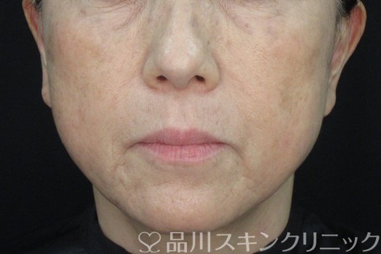 症例NO.72850のAFTER写真