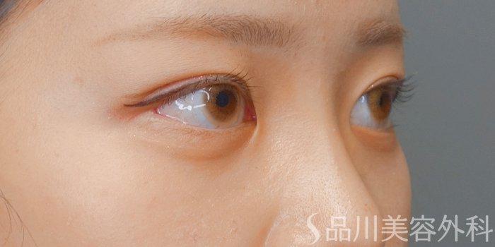 症例NO.73136のAFTER写真