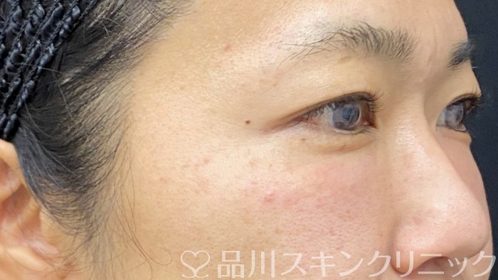 症例NO.73582のAFTER写真