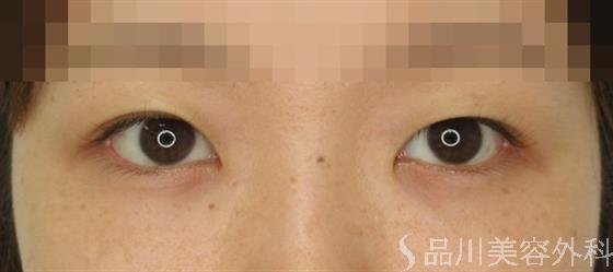 症例NO.48962のBEFORE写真