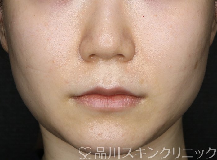 症例NO.70467のAFTER写真