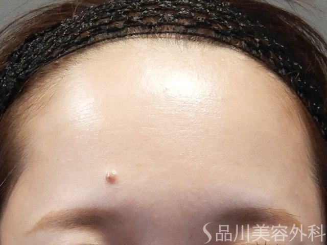 症例NO.64983のBEFORE写真