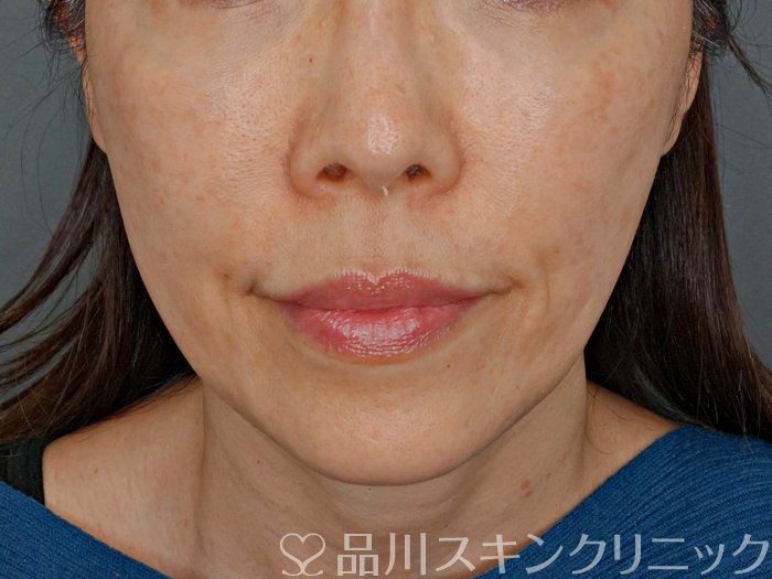 症例NO.73983のBEFORE写真