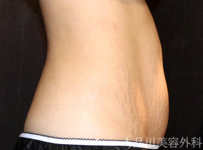 症例NO.70097のBEFORE写真