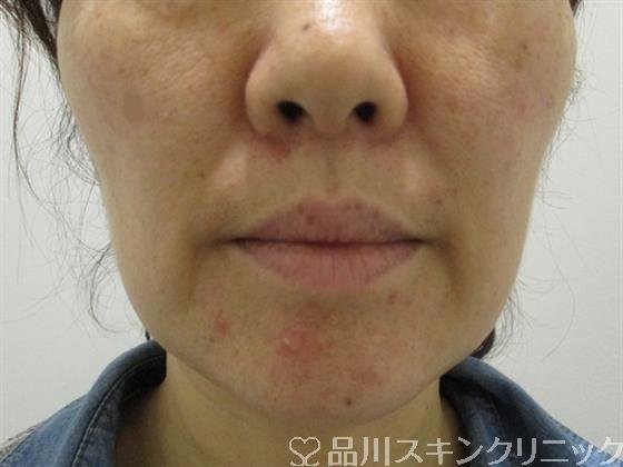 症例NO.33484のBEFORE写真