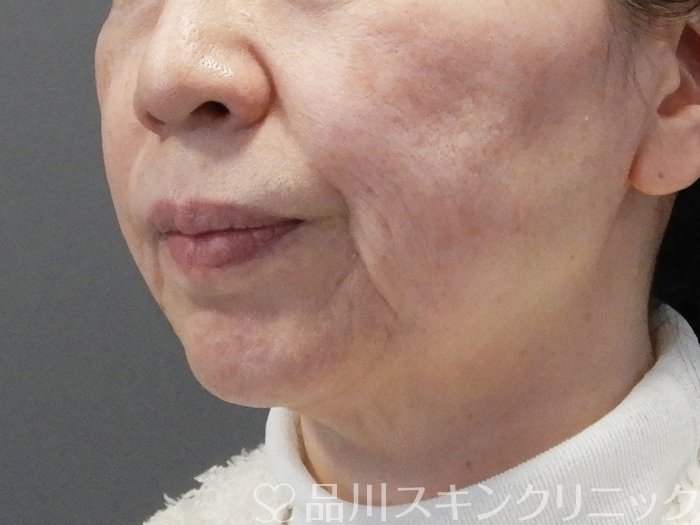 症例NO.73037のBEFORE写真