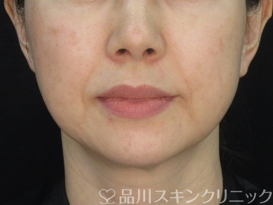 症例NO.72425のAFTER写真