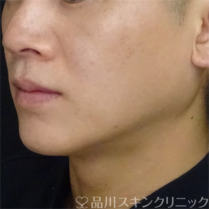 症例NO.69605のAFTER写真