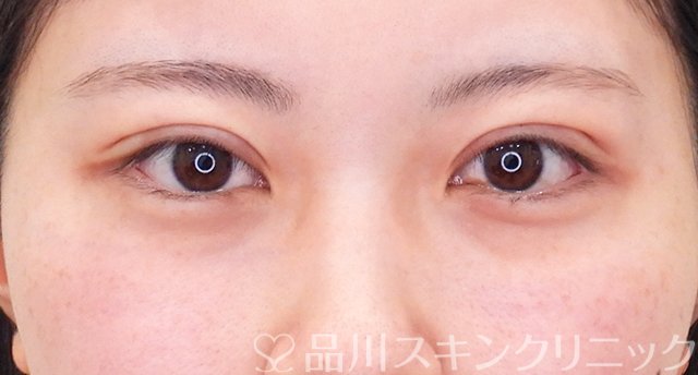 症例NO.62291のAFTER写真