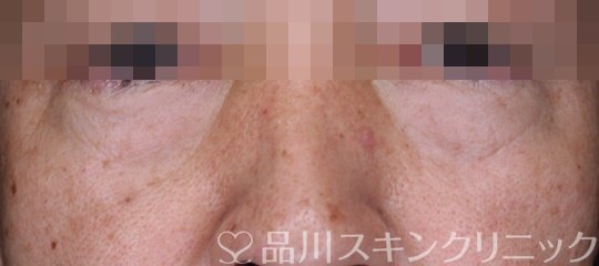 症例NO.64035のBEFORE写真