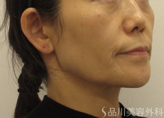 症例NO.72707のBEFORE写真