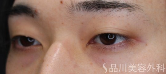 症例NO.69452のBEFORE写真