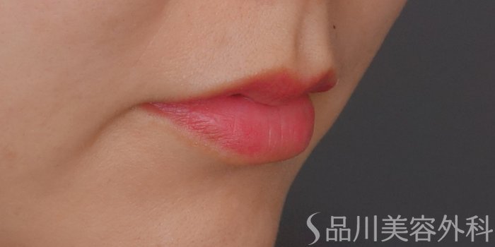 症例NO.71763のBEFORE写真