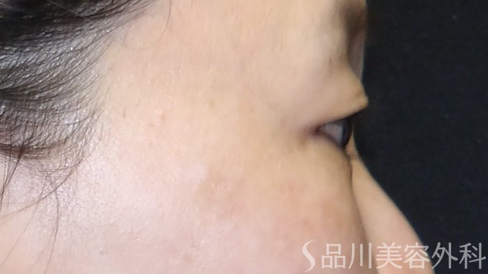 症例NO.73668のBEFORE写真