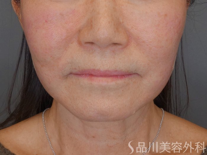 症例NO.72365のAFTER写真