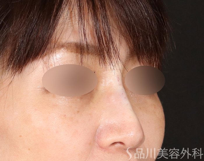 症例NO.71047のAFTER写真