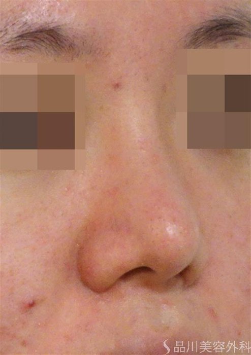 症例NO.40038のAFTER写真