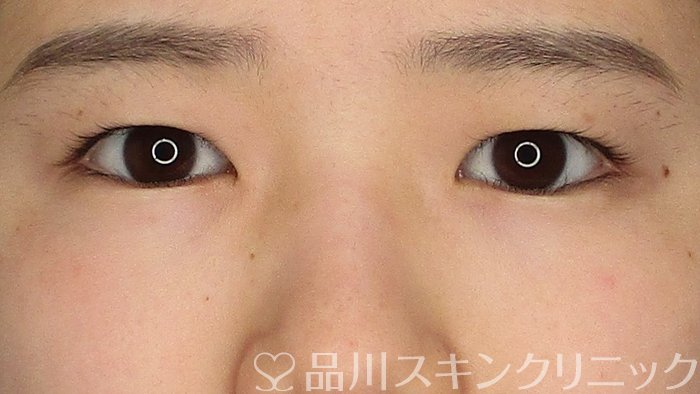 症例NO.73867のBEFORE写真
