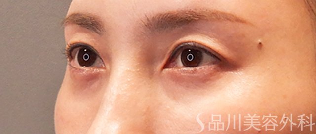 症例NO.71085のAFTER写真