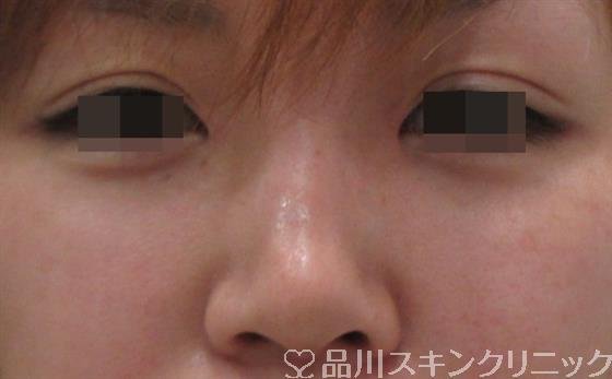 症例NO.26181のAFTER写真