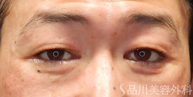 症例NO.74435のAFTER写真