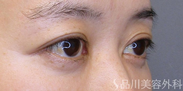 症例NO.75203のBEFORE写真