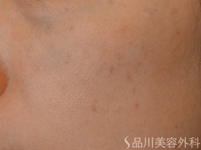 症例NO.72827のAFTER写真