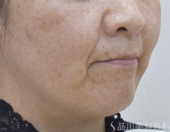 症例NO.48022のBEFORE写真
