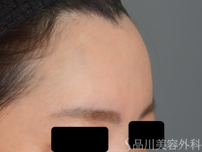 症例NO.69750のAFTER写真