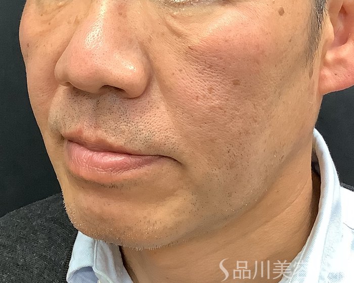 症例NO.69643のBEFORE写真