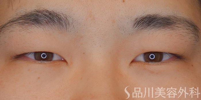 症例NO.70328のBEFORE写真