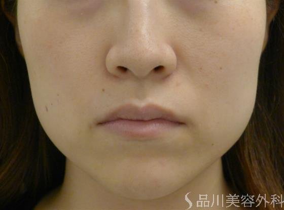 症例NO.50115のBEFORE写真