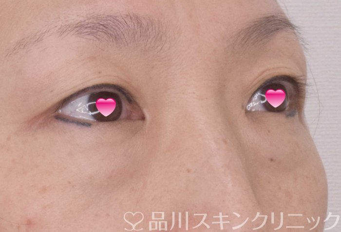 症例NO.69526のBEFORE写真