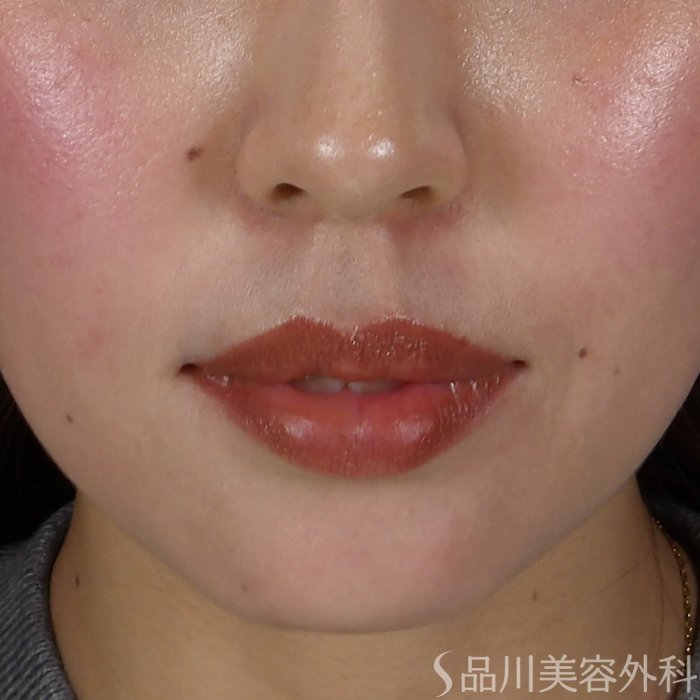 症例NO.71117のBEFORE写真