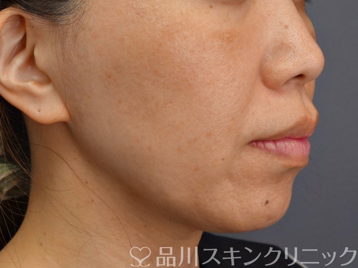 症例NO.74005のBEFORE写真
