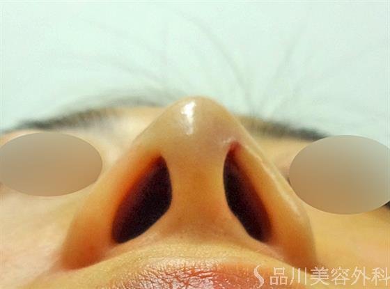 症例NO.25958のAFTER写真