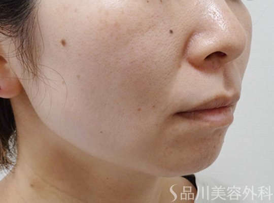 症例NO.74061のAFTER写真