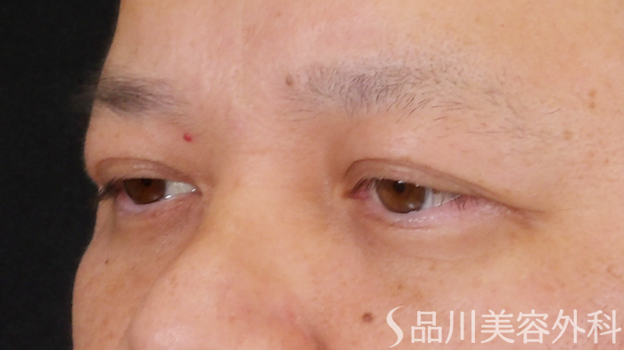 症例NO.70527のAFTER写真