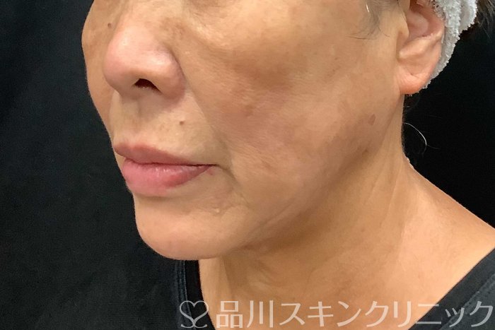 症例NO.69776のAFTER写真