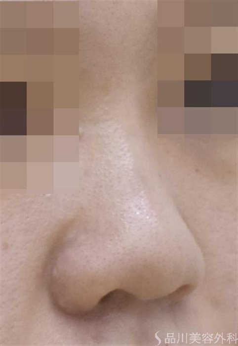 症例NO.48943のBEFORE写真