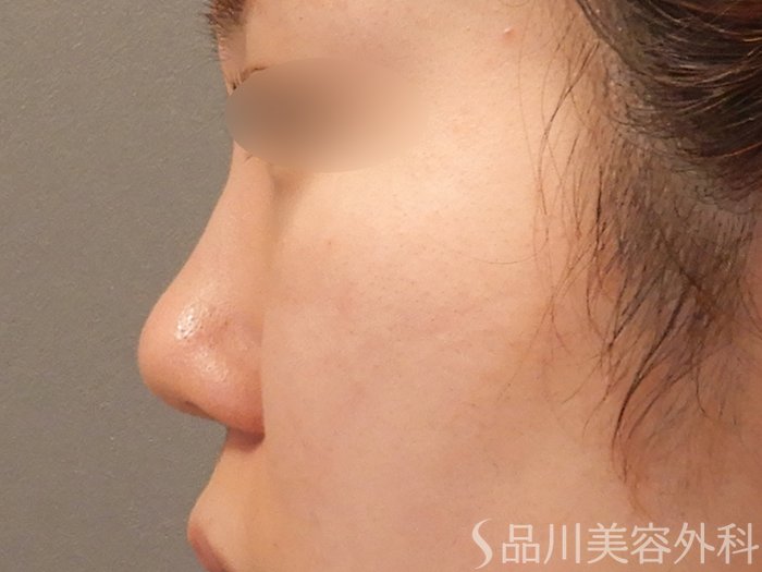 症例NO.71019のBEFORE写真